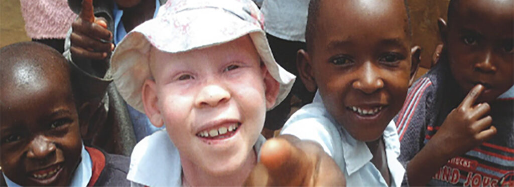 La tragedia de nacer albino en África